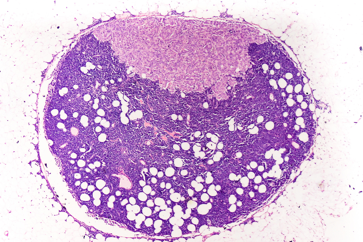 1200x800_cancer_de_mama